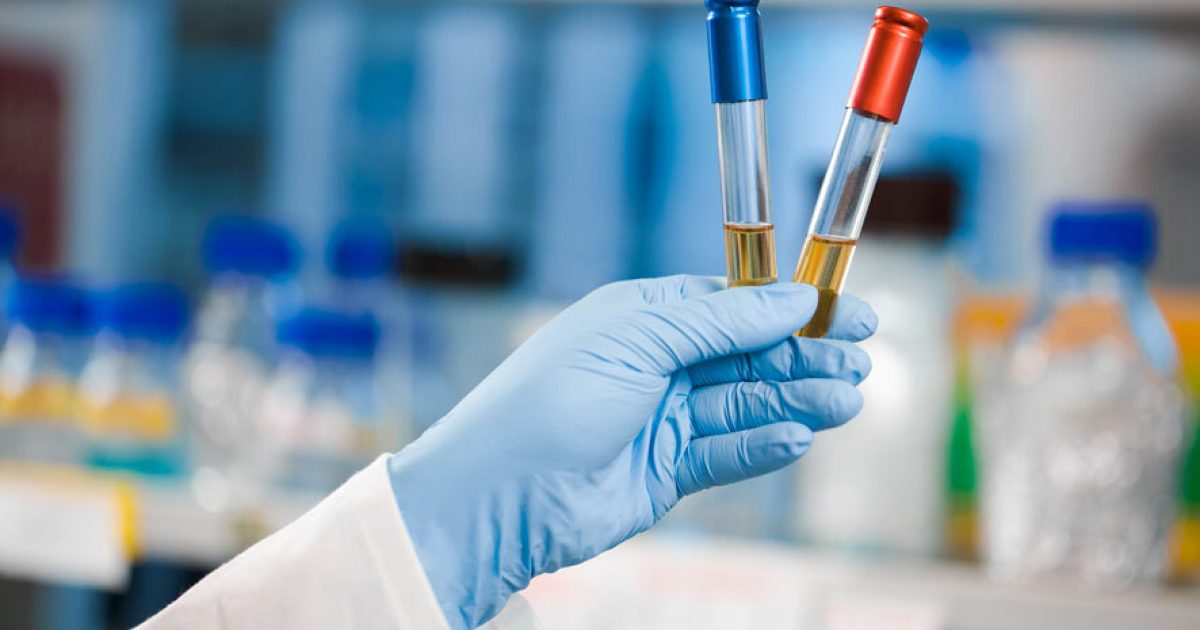 Urine laboratory drug tests in London | Drug Testing London