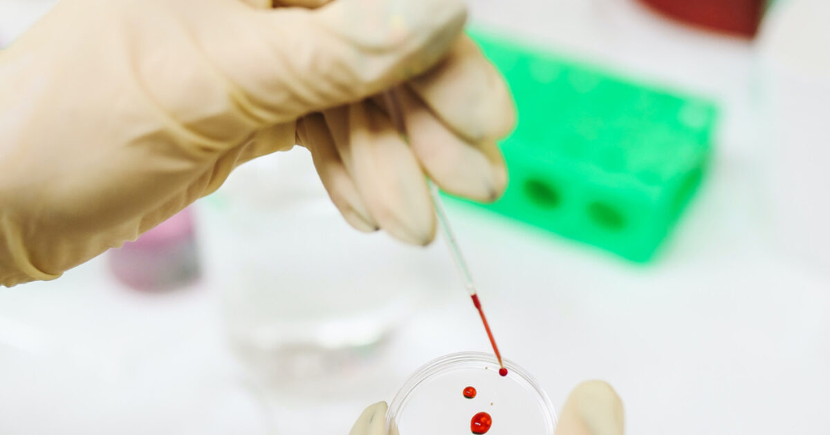 PEth alcohol testing Court approved ISO 17025… Crystal Health